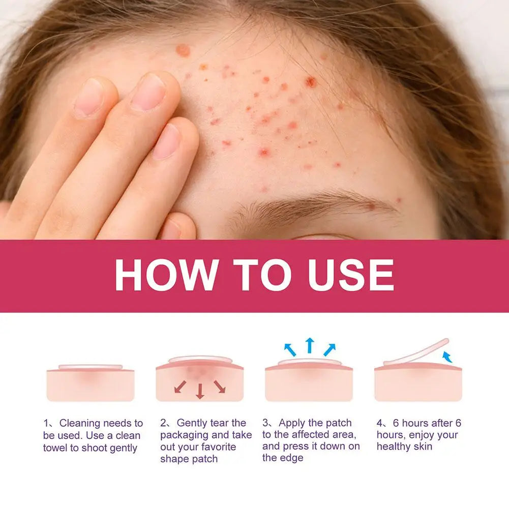 Star Pimple Patch - Acne Removal Skin Care Stickers